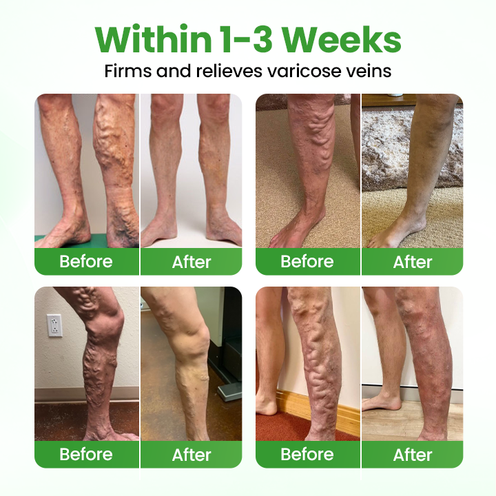 Healrize® VeinHeal Microneedle Patch.