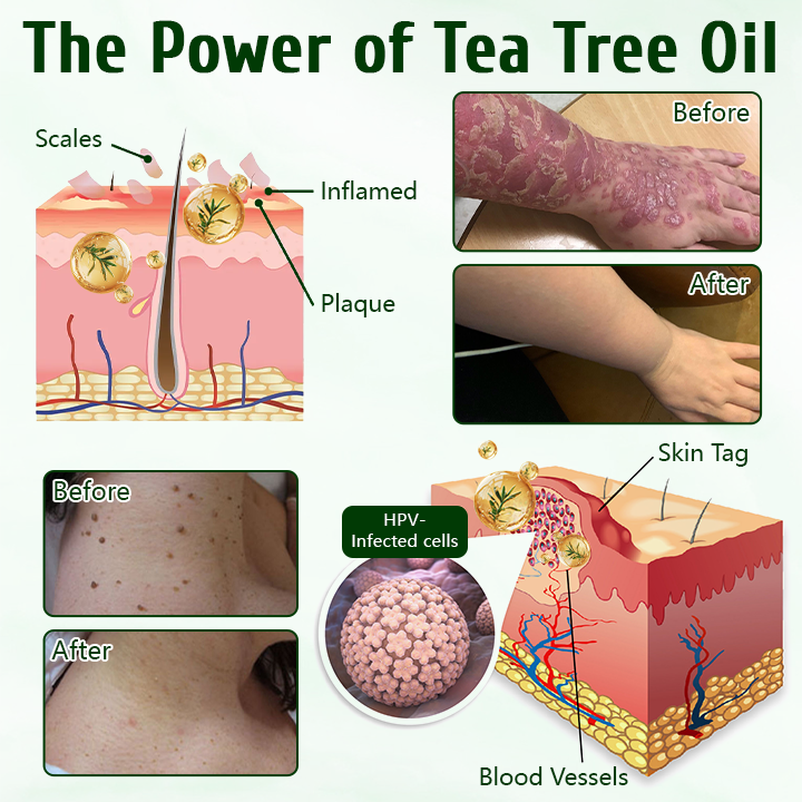 Timilk® DermaPure Tea Tree Healing Cream.