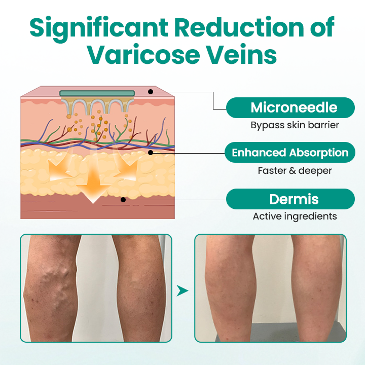 Timilk® LegRenew Varicose Veins Patch.
