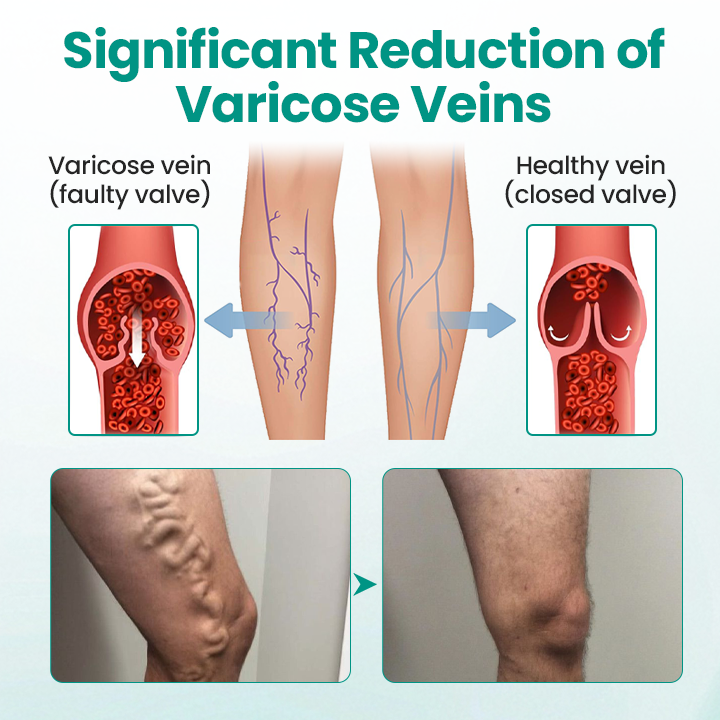 Timilk® LegRenew Varicose Veins Patch.